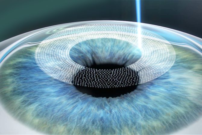 Opération lasik