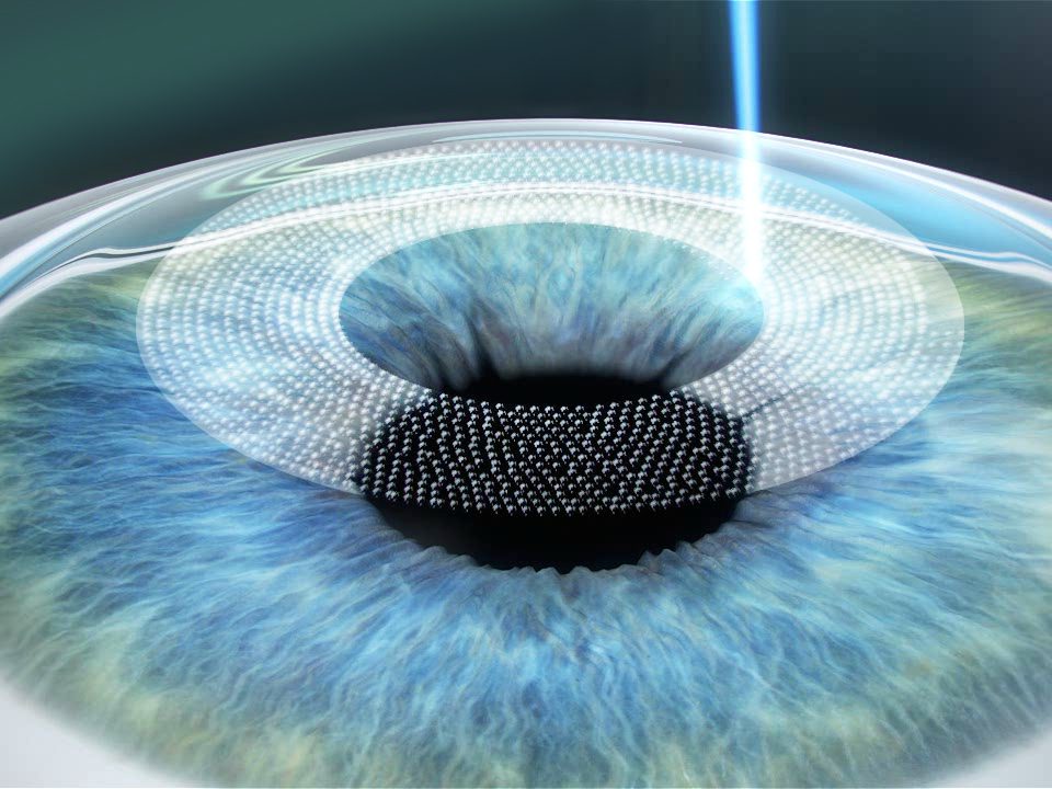 Opération lasik