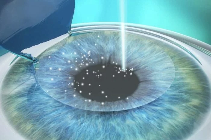 Lasik et presbylasik
